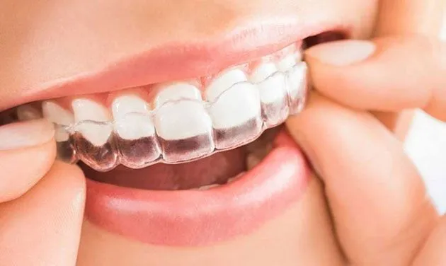 Ortodoncia Invisible: ¡Olvídate de los Brackets!