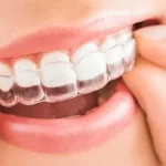 invisalign queretaro